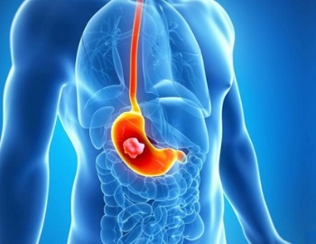 �alerta, c�ncer de est�mago, det�ctalo a tiempo