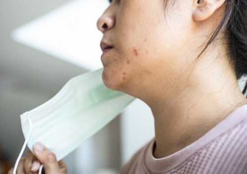 granos en la piel por oclusi�n