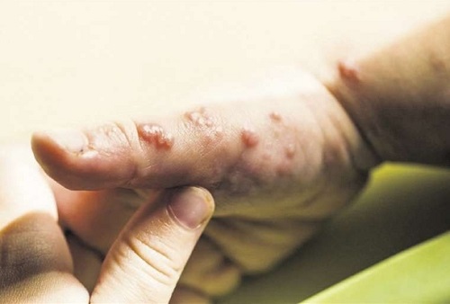 ni�o menor de 16 a�os contagiado